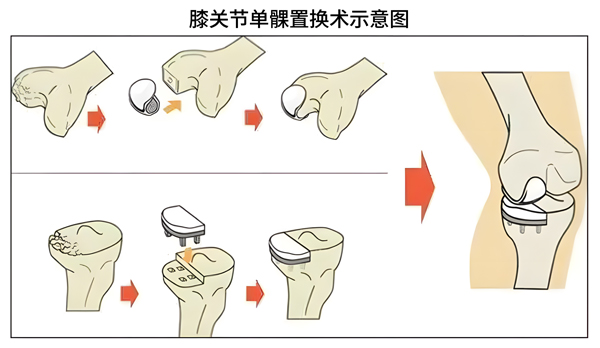 ai升图  修改 膝关节单髁置换术示意图